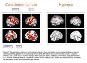 hypnose IRM